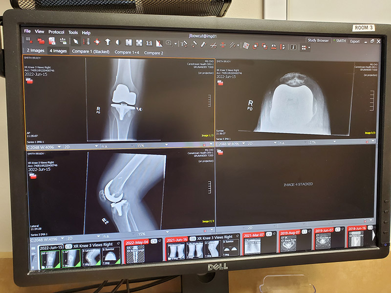 X-ray of knee after replacement.